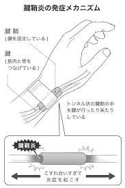 テーピングで治せる 手首の腱鞘炎やバネ指の原因と症状 1分でできるセルフケア ケンカツ health tips health health care