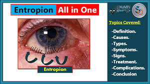 Image result for Entropion