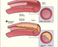 Image of Atherosclerosis diagram
