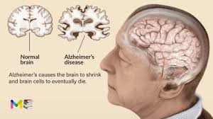 Alzheimer's Disease: Stages, Causes, Symptoms &amp; Treatment