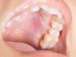 When you get a virus, you may not always get sick from it. Mouth Sores Causes Treatment And Pictures