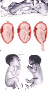 Image result for Breech Delivery