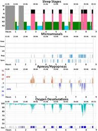 Image result for Polysomnogram