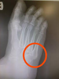 Sharp Shooting Pain Under Pinky Toe Causes Best Treatment 2020