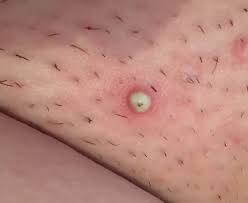 Ein pickel an der schamlippe im intimbereich vorkommt, ist auch für den medizinischen laien leicht zu erkennen. Kann Mir Jemand Sagen Was Das Ist Pickel Gesundheit