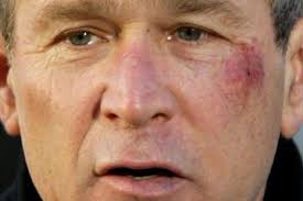 What would happen if you pop a vein in your hand?