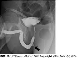 Image result for Retrograde Urethrogram