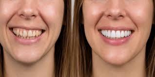 Best All-On-X Dental Implants in Austin