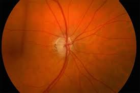 Jan 21, 2018 · glaucoma is one of the most common illnesses affecting the optic nerve. Glaucomatous Optic Nerve Image Eurekalert Science News