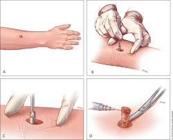 Shave removal is when the lesion has been removed. Shave And Punch Biopsy For Skin Lesions American Family Physician