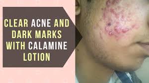 It helps to dry and shrink the pustules caused by inflammatory while calamine lotion may help dry up acne lesions and surface oil, it doesn't address acne's cause. Clear Acne And Dark Marks With Calamine Lotion Youtube