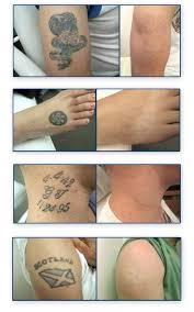 In general, this is what you should expect during a laser tattoo removal session: Tattoo Removal Before And After Tattoo Removal Laser Tattoo Tattoo Removal Cost