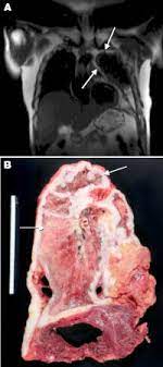 Findings from the study, led by boyi gan, ph.d., associate professor of. Mesothelioma