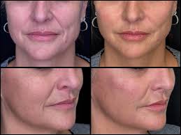 Meet Springfield's Newest Medical Injector! Ashley Ribaudo, sole owner of  Prima Bella Aesthetics, is a board certified family nurse practitioner with  full practice authority in the state of Illinois. Shortly after graduating