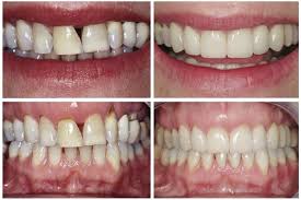 Composite bonding, for example, only costs about £90 to £200, which means you can easily afford to have several of your teeth bonded. Discoloured Teeth Teeth Whitening Windsor