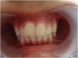 Maybe you would like to learn more about one of these? Tuberculate Supernumerary Teeth And Its Management A Rare Case Report Medcrave Online