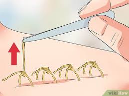 Como Quitar Suturas 15 Pasos Con Imagenes Wikihow