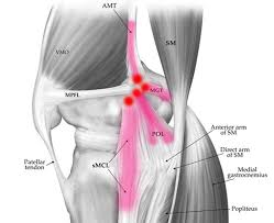 Pellegrini Steida Syndrome A Cause Of Stubborn Medial Knee Pain