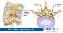 Image result for icd 10 code for central stenosis of spinal canal