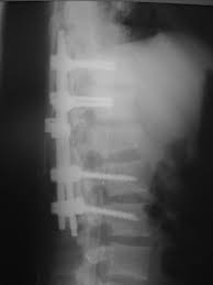 Fratua de coluna vertebral