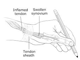 Plantar flexion describes the extension of the ankle so that the foot points down and away from the leg. De Quervain S Tendinosis Symptoms And Treatment Orthoinfo Aaos
