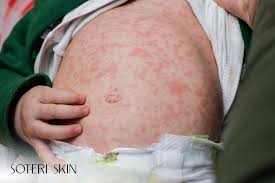Image result for sweat rash on back baby