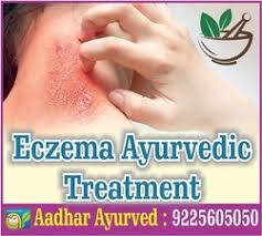 Spreading awareness about eczema in india. Eczema Treatment Service In India
