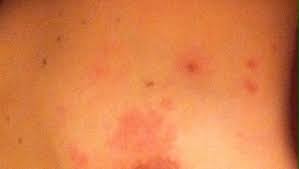 Swelling and redness that affects at least 1/3 of your breast. Breast Cancer Topic Rash Awaiting Biopsy Results Scared