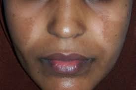 Image result for Melasma