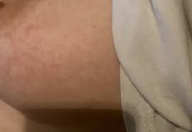 Usual features of inflammation are skin thickening, redness and warmt. Breast Cancer Rash Cancerwalls