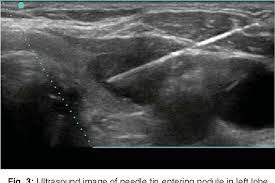 Thyroid ultrasound and FNAC support