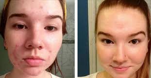 Ces boutons sont bombés, rouges ou parfois, avec un bout blanc. Masque Visage Maison 5 Recettes Pour Eliminer Les Boutons D Acne