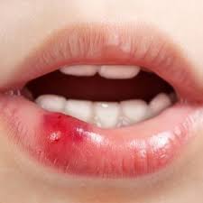 Pin By Fae On Oc L Tyler Moya Lip Treat Swollen Lips Kylie Jenner Lips