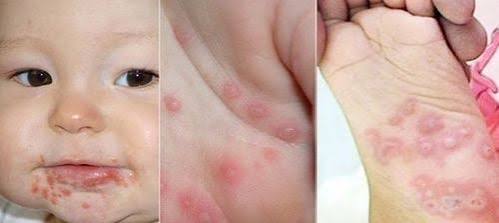 PHÒNG CHỐNG BỆNH CHÂN – TAY – MIỆNG Ở TRẺ MẦM NON