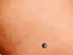 Image result for Blue Nevus