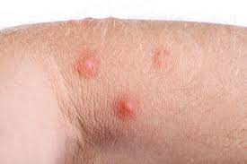 Momento Da Seguranca Wa Alergia A Picadas De Mosquitos Pulgas E Carrapatos
