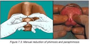 Image result for paraphimosis