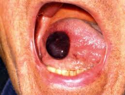 Mouth blood blister inside cheek. Angina Bullosa Haemorrhagica Dermnet Nz