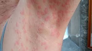 Shop now for natural eczema treatments: ErupÈiile Cutanate Un Nou Simptom Al InfecÈiei Cu Noul Coronavirus Cum Le RecunoaÈteÈi Foto Stirileprotv Ro