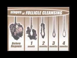 Their treatments are all natural containing products such as saw palmetto, which does not combat mpb, and tea tree oil which once again has nothing to do with mpb. Regenix Fox Klac S Petros Uses Regenix To Stop Hair Loss Can Use W Rogaine Youtube