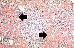 Material does not take up silver with the jms method. Iplab Lab 6 Amyloidosis Pathology Education Instructional Resource