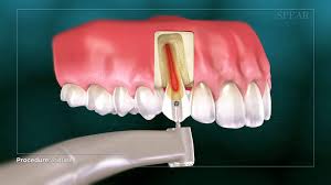 Many dental insurance policies at least partially cover endodontic treatment. Dentist 22181 Vienna Cosmetic Family Dentistry Root Canal Therapy