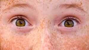 Image result for Freckled skin