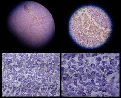 Mesothelioma is a cancer that most commonly starts in the layers of tissue that cover eac. What Is Mesothelioma Definition Symptoms Causes Study Com