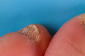 Image result for Clubbing nails feet