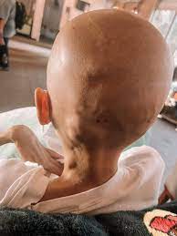 ♥️UPDATE ON SASHA Sasha, is a beautiful child whose strength, endurance,  and light, inspire us all. She has been in the fight with Ewing's Sarcoma  over 3 years through difficult protocols and
