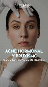 🔴 “¡Mi piel pedía ayuda y no lo sabía! 😱”, Así fue como descubrí que mi  acné hormonal tenía solución. 💆‍♀️✨ Después de años luchando con brotes,  también entendí que mi bruxismo y el estrés estaban ...