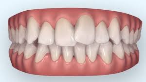 Hat von euch jemand erfahrungen was die zahnregulierung mit clear aligner angeht? Ihr Invisalign Spezialist In Lippstadt Dr Bianca Mertens