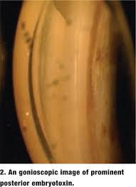 Image result for Gonioscopy