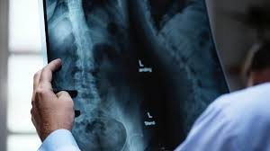 This may be particularly useful in treating primary and metastatic lung cancers. Lung Cancer No Cancer Hope Courage Answers
